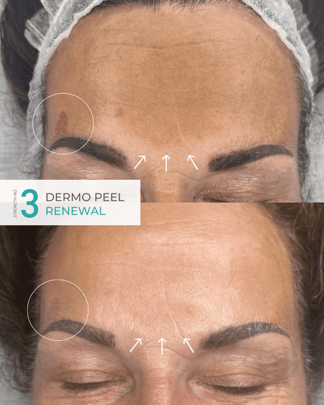 Bio-microneedling Dermo Peel so spikulami RENEWAL Nº3 – Obrázok 8